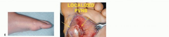 Illustration 17 for Treating Tumors of the Foot: Optimizing Amputation & Resection