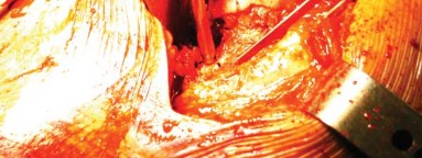 Illustration 10 for S-ROM: Inside the Technique of Modular Implant Design