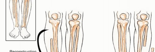 Illustration 40 for Beyond Amputation: The Type I Resection in Fibular Tumor Surgery