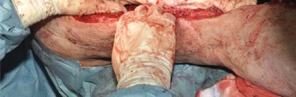 Illustration 82 for Optimizing Infected THA: The One Staged Approach Explained