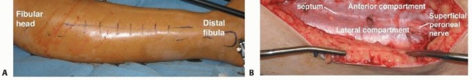 Illustration 10 for Acute Compartment Syndrome: Timely Fasciotomy Explained