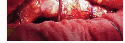 Illustration 6 for Cemented Total Hip: A Successful & Evidence-Based Solution