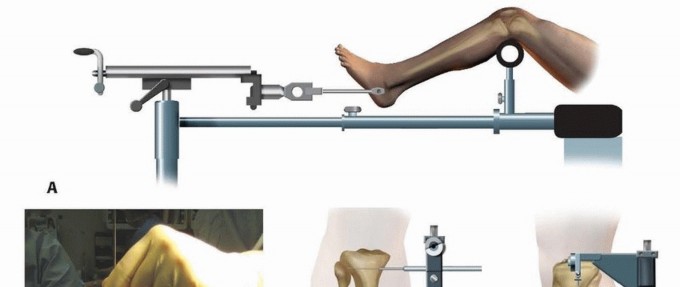 Illustration 15 for Advanced Nailing of the Mature Tibia: Overcoming Complexities