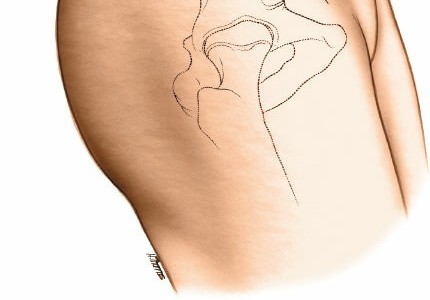 Illustration 24 for Pelvis & Acetabulum Approaches: Unlocking the Posterior Superior Iliac