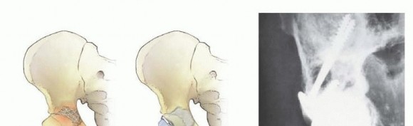 Illustration 4 for Regain Mobility: Total Hip Arthroplasty for Malignant Lesions