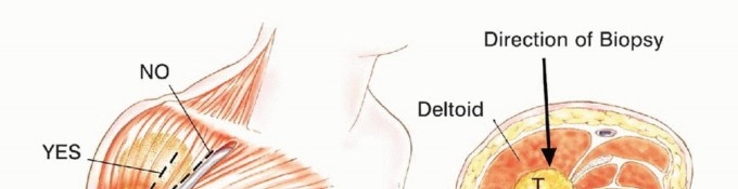 Illustration 5 for Mastering Total Scapular Resections: Reconstruction & Outcomes