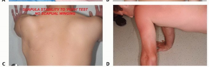 Illustration 19 for Mastering Total Scapular Resections: Reconstruction & Outcomes