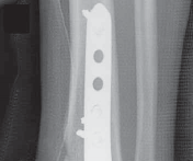 Illustration 48 for Optimizing ORIF for Tibial Plafond Fractures: A Modern Approach