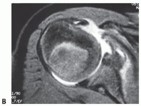Subscapularis Tendon Tears: Advanced Repair & Biceps Solutions