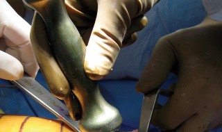 Illustration 17 for Minimally Invasive Subvastus: The Best Path to Quicker TKA Recovery