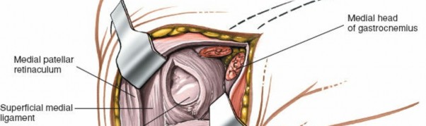 Illustration 82 for Mastering Knee Approaches: Spotlight on Superficial Medial Ligament