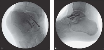 Illustration 3 for Displaced Talar Neck Fracture: Optimal Treatment Revealed