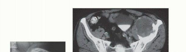 Illustration 48 for Pelvic Metastasis Surgery: A Component of the Utilitarian Approach