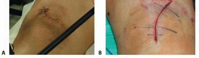 Illustration 32 for Repairing Distal Femur Fractures: Open Reduction & Internal Fixation