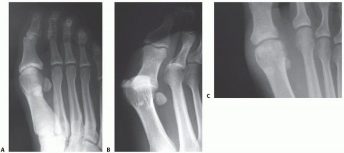 Illustration 9 for Restore Your Foot: Surgical Treatment for Hallux MP Joint Turf Toe