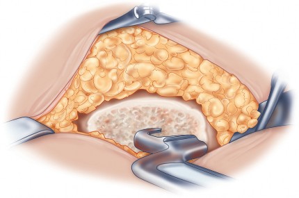 Illustration 62 for Direct Lateral Hip: Optimize Exposure with Sharp Curved Hohmann