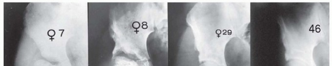 Illustration 13 for Labral Support Shelf Procedure: Preventing Perthes Deformity