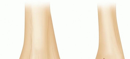 Open Reduction and Internal Fixation of Capitellum and Capitellar-Trochlear Shear Fractures