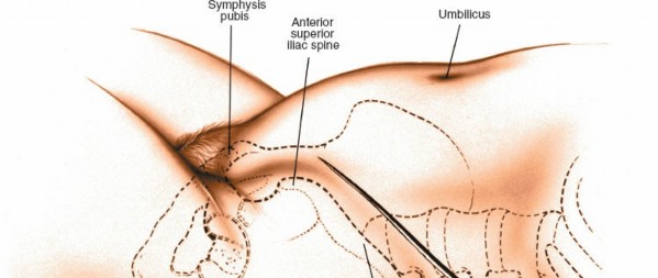 Illustration 3 for Master the Anterolateral Retroperitoneal Approach to Lumbar Spine