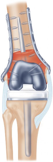 Illustration 9 for Structural Allografting Figure Guide: Solutions for Bone Deficiency