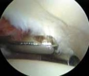 Illustration 22 for Solving Hip Soft Tissue Pathology with Advanced Arthroscopy