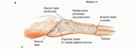 Illustration 40 for Tackling Complex Tumors of the Proximal Tibia: Limb-Sparing Solutions