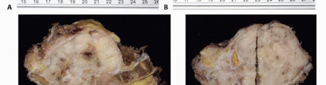 Illustration 61 for Sacral Tumor Surgery: Safeguarding Bowel & Bladder Control