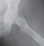 Illustration 22 for Advanced Arthroplasty for Malignant Lesions: Reclaim Your Mobility