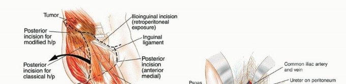 Illustration 10 for Posterior Flap Hemipelvectomy: Mastering Techniques for Optimal Outcomes