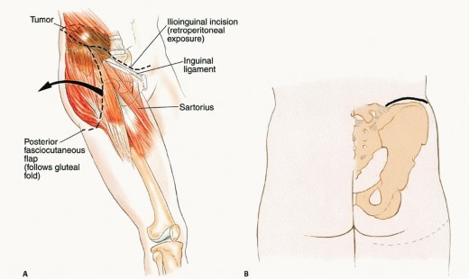 Illustration 20 for Surgical Pelvic Resection: Gluteus Maximus Muscle & Nerve Preservation