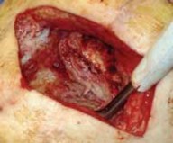 Illustration 7 for Knee Arthrodesis: A Lifelong Knee Solution for Trauma & TKA