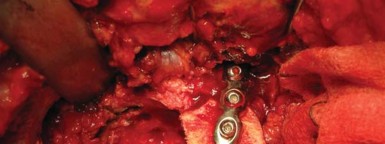 Illustration 29 for Navigating Early THA for Fractures of the Acetabulum