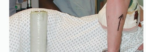 Illustration 7 for Distal Humeral Fractures: When Is Elbow Replacement the Best Option?