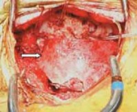 Illustration 15 for Cervical Fusion: The Line is Drawn for Lasting Stability