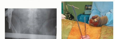Illustration 18 for Emergency Fixation of the Pelvis: Control Bleeding & Restore Stability