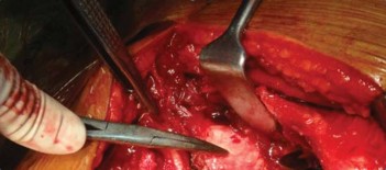 Illustration 14 for Optimizing Arthroplasty in Acute Fractures: Octopus System