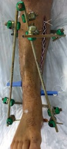 Illustration 9 for Complex Tibial Shaft Fracture: Plate Fixation for Plafond Extension