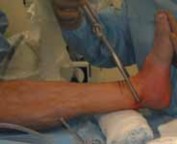 Illustration 38 for Optimal Fixation of the Ankle: Open Reduction & Internal Fixation