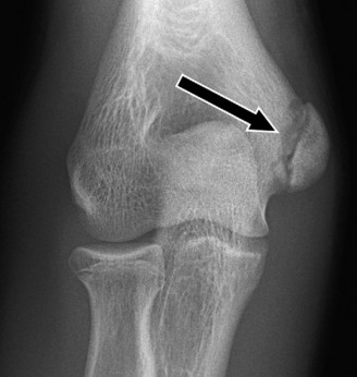 Illustration 100 for Right Shoulder Pain? Avoid This Common X-ray Mistake.