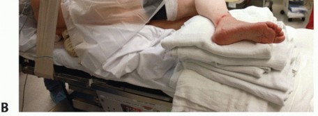 Illustration 20 for Unlock Stability: Medullary Nail Fixation for Tibiotalocalcaneal Arthrodesis