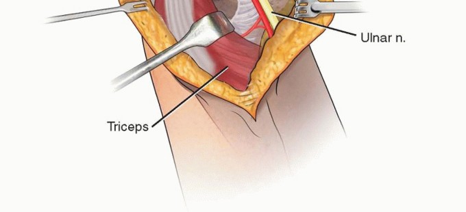 Illustration of fixation of pediatric - Dr. Mohammed Hutaif
