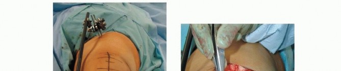 Illustration 43 for Repairing Distal Femur Fractures: Open Reduction & Internal Fixation