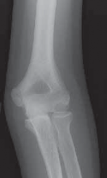 Illustration 4 for Precision Arthroscopy for Chondral Injuries & OCD: Direct Lateral Portal