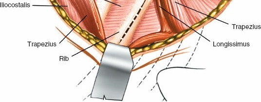 Illustration 295 for Approach to the Lumbar Spine: Mastering Techniques & Anatomy