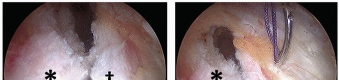 Illustration 34 for Beyond Knee Surg: Hip Arthroscopy for Sports Injuries