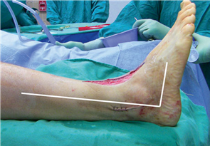 Illustration 10 for First Metatarsal Surgery: Expert Solutions for Foot & Ankle Pain