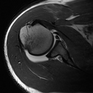 Illustration 7 for Right Shoulder Pain? Avoid This Common X-ray Mistake.
