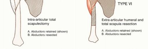 Illustration 9 for Limb-Sparing Resections Around the Shoulder: Optimizing Outcomes