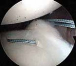 Illustration 28 for Regain Stability: Anterior Shoulder Instability Arthroscopic Fix