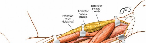 Illustration 72 for Mastering Approaches to the Upper Third of the Radius